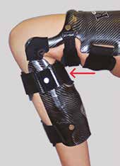 Bei der PCL-Version kann der Tibiavorschub über ein gelenknahes breites Velcro-Band am Unterschenkel stufenlos eingestellt und das Knie dorsolateral gut stabilisiert werden.