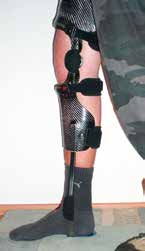 Bei komplexem Trauma und starker Atrophie der Wadenmuskulatur muss die Knieorthese mit einem Fußteil zur Vermeidung einer Distalisierung versehen werden.