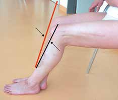 Bei alter fixierter hinterer Schublade nach Trauma wird die Orthese zuerst zum Aufdehnen der Kniegelenkkapsel eingesetzt. Erst danach kann die Rekonstruktion des hinteren Kreuzbandes erfolgen.