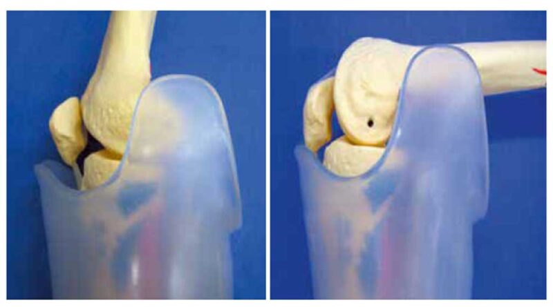 Bewegungsfreiraum des Kniegelenkes im modifizierten Schaft.