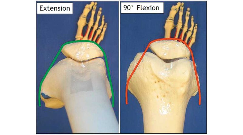 In der Horizontalebene sichtbare Formänderung des Kniegelenkes bei Flexion. Die Druckbelastung steigt hauptsächlich am medialen Femurkondylus.