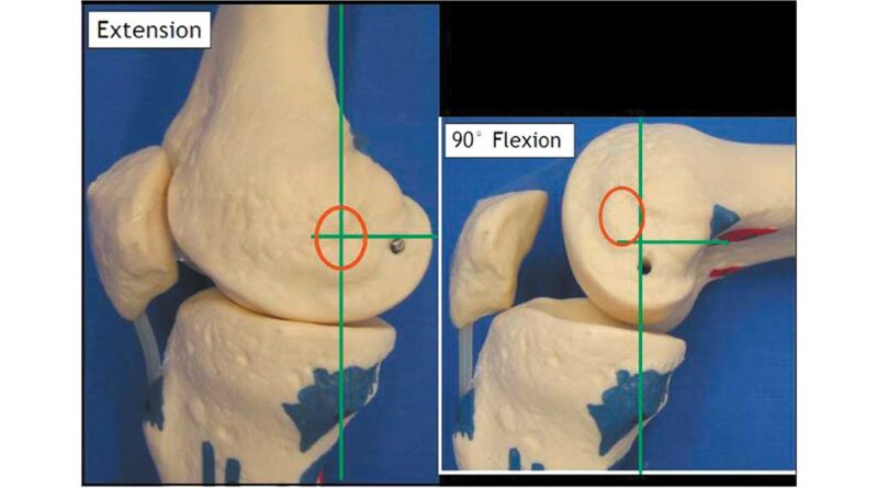 Die breiteste Stelle der Femurkondylen wandert bei Flexion nach anterior proximal.