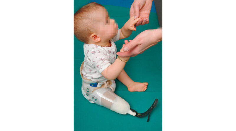 Erstversorgung mit beweglichem PP-Fuß, ohne Kniegelenk, aber mit Beckenkorb.