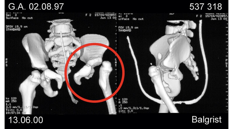 CT-Rekonstruktion: Knöchern wie auch muskulär minder ausgebildete linke Beckenhälfte mit luxiertem Hüftkopf.