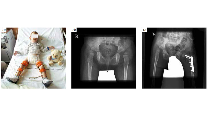 1a: postoperative Lagerungsorthese zur Konsolidierung des OP-Ergebnisses. 1b: Röntgenaufnahme präoperativ; 1c: Röntgenbild postoperativ.