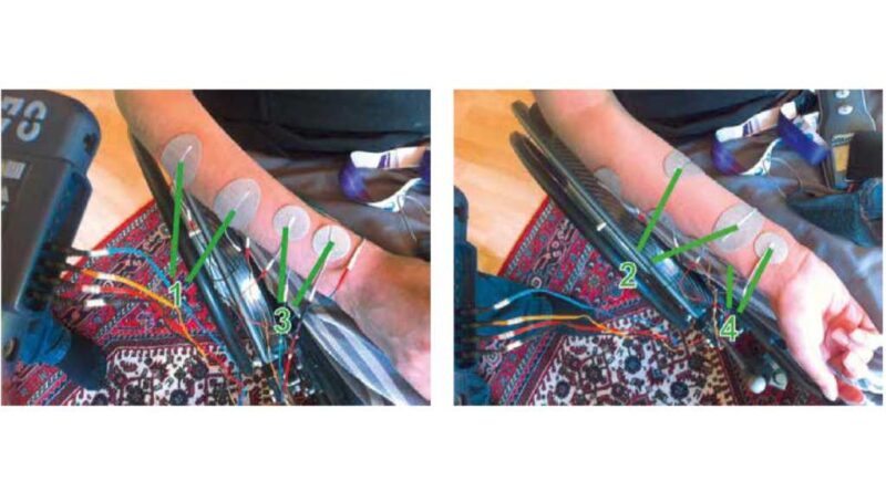 Platzierung der Elektroden für Handextension (1) und Handflexion (2) sowie von Elektrodenpaaren (3) und (4), die sich eine gemeinsame Elektrode teilen und die spezifischen Griffmuster des Daumens erzeugen.
