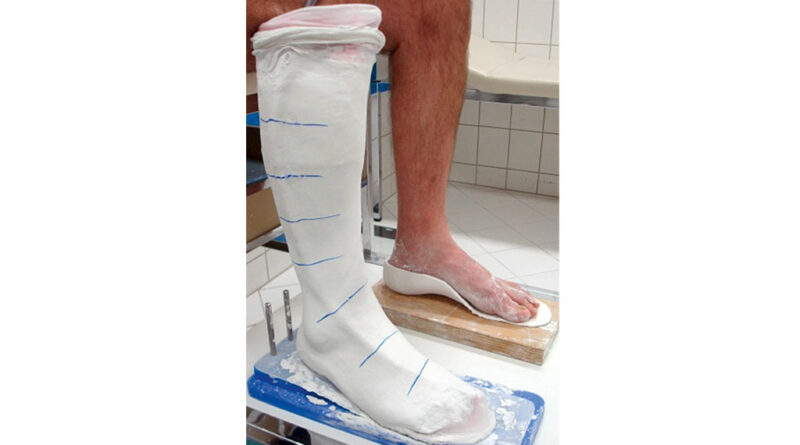 2-Phasen-Gipsabdruck: Am linken Bein ist das Gipsnegativ bereits fertig gestellt, am rechten Bein ist die Abformung des Fußes zu sehen (1. Phase).