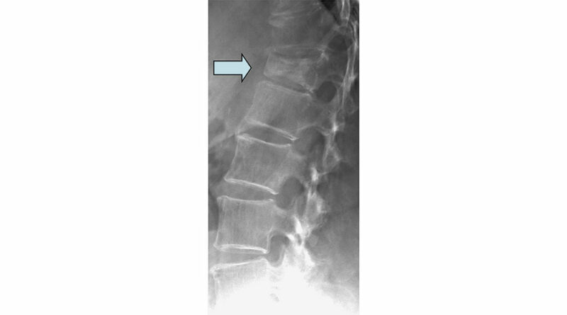 Seitliche Röntgenaufnahme des thorakolumbalen Überganges mit osteoporotischer Sinterungsfraktur LWK 1 (A1.3 nach Magerl) mit Kollaps des Wirbelkörpers im Sinne eines Keilwirbels.
