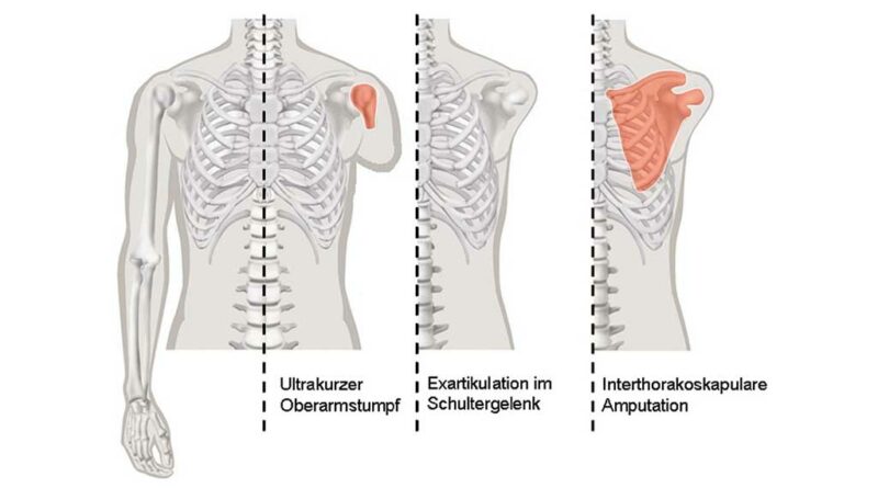 Absetzungen im Bereich des Schultergürtels, nach denen eine Versorgung mit einer Schulterexartikulationsprothese notwendig ist. Im rot markierten Bereich liegen die Amputationslinien.