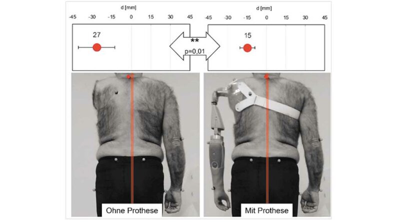 Ergebnisse des Abstands von C7 zur Wirklinie der vertikalen Bodenreaktionskraft von Amputierten mit Absetzungen im Bereich des Schultergürtels mit (rechte Seite) und ohne (linke Seite) Prothese.