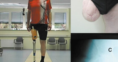 Oberschenkelamputierter mit kurzem transfemoralem Stumpf (a: ganganalytische Situation; b: Stumpf in frontaler Ansicht; c: zugehöriges Röntgenbild).
