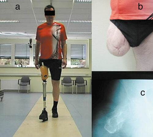 Oberschenkelamputierter mit kurzem transfemoralem Stumpf (a: ganganalytische Situation; b: Stumpf in frontaler Ansicht; c: zugehöriges Röntgenbild).