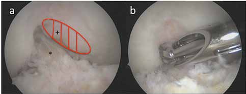 Notch-Impingement durch degenerative Osteophyten-Bildung (+), die das vordere Kreuzband (*) bei Streckung einklemmen. b) Abtragung mit einer Kugelfräse.