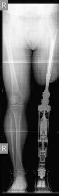 Abb. 1b Röntgenaufnahme mit im Knochen verankerter Osseointegrationsprothese.