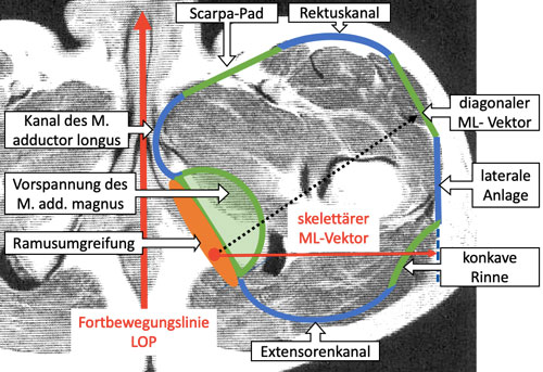 Funktionelle Bereiche der Schafteintrittsebene eines anatomischen Schaftes auf dem MRT-Querschnitt eines Oberschenkels.