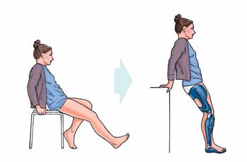 Extensionsdefizit im Knie. Falsche Position beim Gipsen in zu großer Plantarflexion (l.). Der zurückverlagerte Körperschwerpunkt macht das lotgerechte Stehen in der Orthese unmöglich (r.).