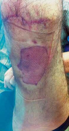 Patient nach Motorradunfall mit nachfolgender Kniegelenkexartikulation und Weichteildefekt an der Oberschenkelrückseite