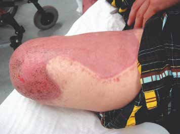 Amputation nach einem Starkstromunfall mit ausgedehnten Verbrennungen der Haut am Oberschenkel