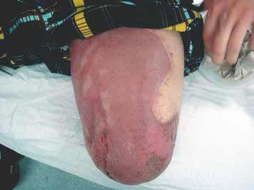 Amputation nach einem Starkstromunfall mit ausgedehnten Verbrennungen der Haut am Oberschenkel