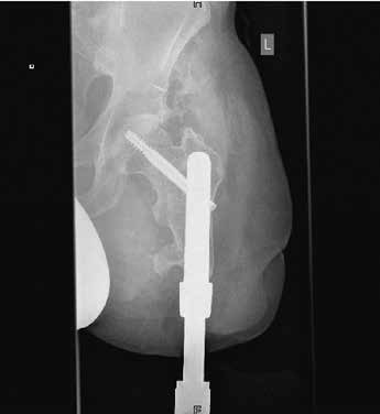 a.–p.-Röntgenbild einer Endo-Exo-Versorgung mit proximaler Tragschraube bei kurzem Restknochen.