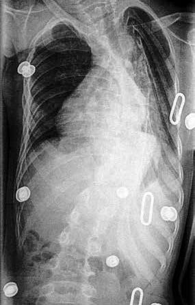 Patient aus Abbildung 2a u. b, Röntgenbild im Korsett.