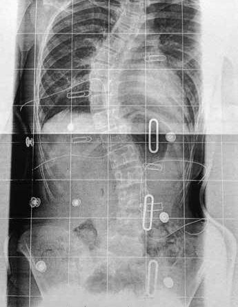 Röntgenbild im markierten Korsett; hier ist die deutlich zu tiefe Position der thorakalen Druckzone und des hochthorakalen Gegenhaltes sichtbar.