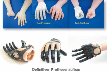 Aufbau einer myoelektrischen Partialhandprothese mit Integration der kompletten Technik im Handbereich.