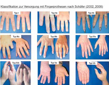 Klassifikation zur Versorgung mit Silikon-Fingerprothesen nach Schäfer.