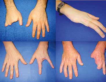Unterschiedliche Arten der partiellen Handamputation.