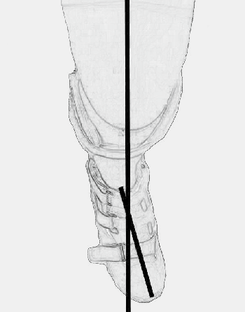 Bei hängendem Unterschenkel muss am sitzenden Patienten der Fuß in Richtung Oberschenkelachse stehen.