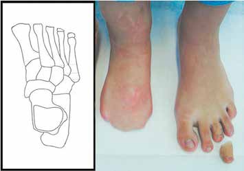 Fehlende Zehenanlagen bei angeborener Fehlbildung des rechten Fußes, links angeborene Fehlbildung von D3.