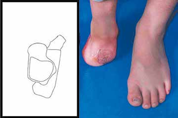 Fußwurzel-Stumpf rechts mit Spalthautdeckung.