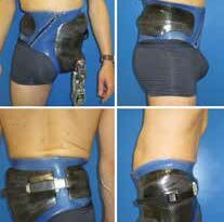 Versorgungssystem: Silikonhose mit zweigeteiltem Beckenkorb und dorsaler Verschlusstechnik.