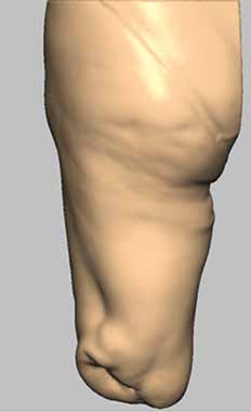 Stumpfrelief (linkes Bild) ohne Anspannung der Muskulatur; Relief nach Formerfassung per Scanning (rechtes Bild) bei angespannter Muskulatur.