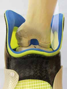 Lateral schafft die flexible Klammer ausreichend Platz für die Biceps-femoris-caput-longum-Sehne sowie den nun tiefliegenden Tractus iliotibialis.