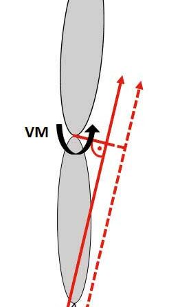 Prinzipskizze zur Erläuterung der Wirkung einer Schuhaußenranderhöhung (die Applizierung der Randerhöhung soll den COP nach lateral verschieben, wodurch sich am Kniegelenk ein reduzierter Hebelarm und somit eine Reduktion des VM ergibt)