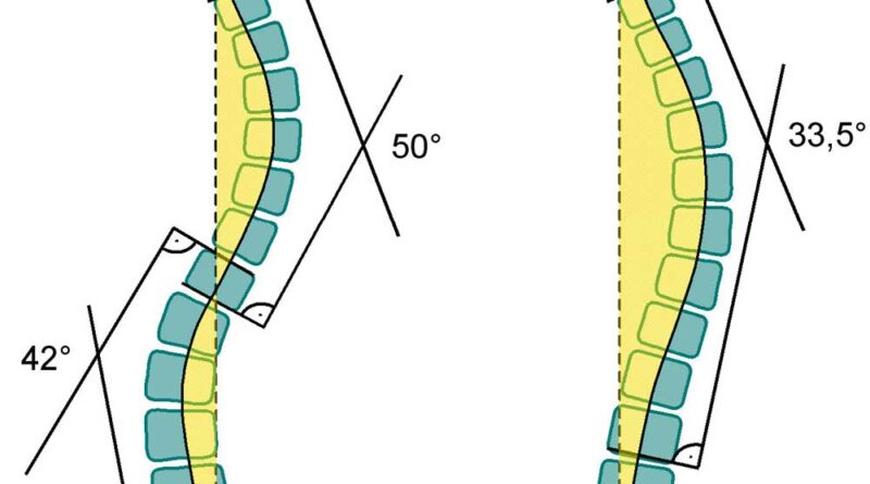Vergleich der Cobb-Winkel von doppel- und einbogigen Krümmungen.