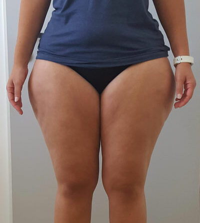 Lipödem II, kein Lymphödem, aktuell BMI 28,9, Maximalgewicht 140 kg vor vier Jahren mit BMI 40,5, WHtR aktuell 0,45; Vorderansicht.