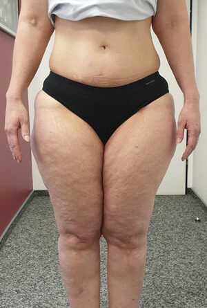 Lipödem III, BMI 28, WHtR 0,5, nach 20 kg Gewichtsabnahme auf 72 kg bei 168 cm Beschwerdefreiheit, jetzt 78 kg mit wieder typischen Beschwerden des Lipödems; Vorderansicht.