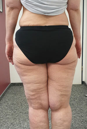 Lipödem III, BMI 28, WHtR 0,5, nach 20 kg Gewichtsabnahme auf 72 kg bei 168 cm Beschwerdefreiheit, jetzt 78 kg mit wieder typischen Beschwerden des Lipödems; Rückansicht.
