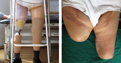 Patient (73,4 Jahre): OS-Amputation rechts (2011), Knieexartikulation links (2006) aufgrund von pAVK und Diabetes mellitus Typ 2.