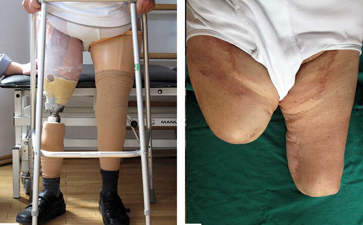 Patient (73,4 Jahre): OS-Amputation rechts (2011), Knieexartikulation links (2006) aufgrund von pAVK und Diabetes mellitus Typ 2.
