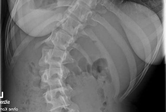 Röntgenbild einer Patientin ohne Doppelschalenkorsett