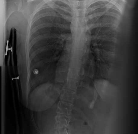 Röntgenbild einer Patientin mit Doppelschalenkorsett