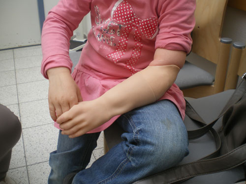 Myoelektrische Unterarmprothese für ein Kind.