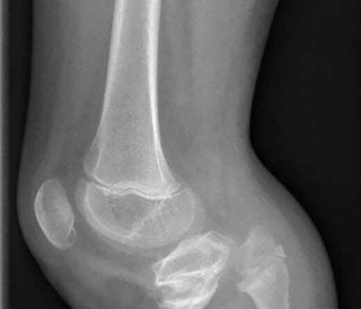 Röntgenaufnahmen eines 9-jährigen Mädchens nach Unterschenkelamputation im Rahmen einer Sepsis.