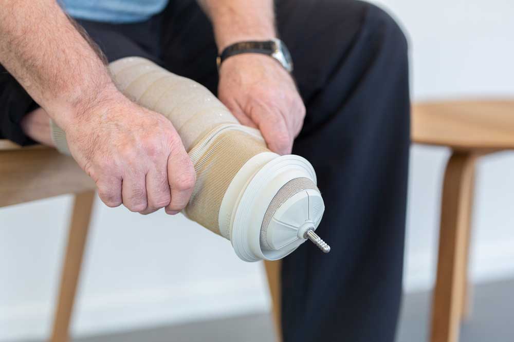 SealIn X LockingLiner & Icelock 562 Hybrid Verlag OrthopädieTechnik