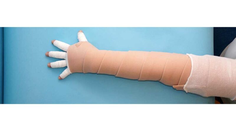 Bandage mit ruhiger Polsterbinde, umgeschlagener Baumwollstrumpf proximal.