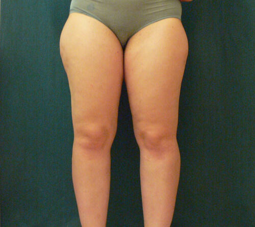 Patientin mit Lipödem-Syndrom (BMI 28 kg/m2).