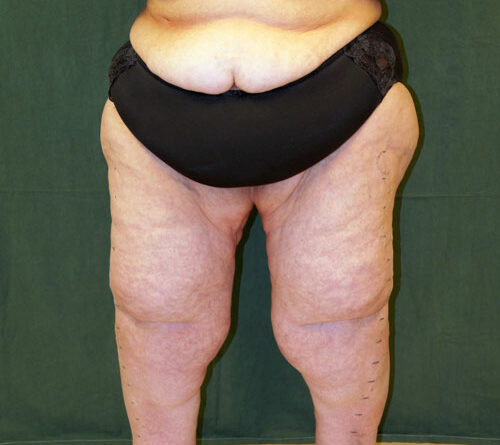 Patientin mit Lipödem-Syndrom und morbider Adipositas (BMI 55 kg/m2).
